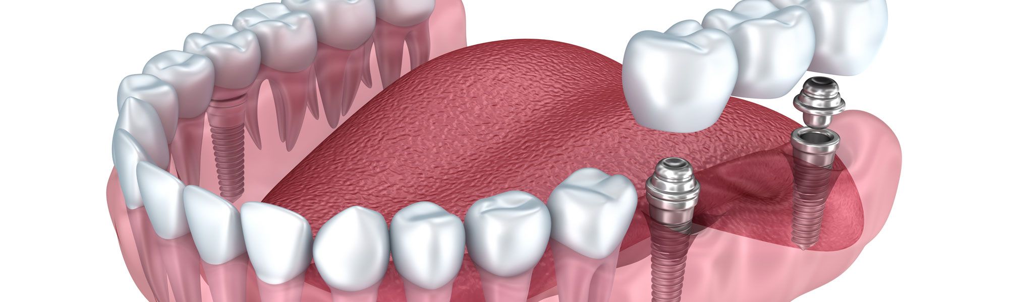 Implantat Zahnarzt Weyhe